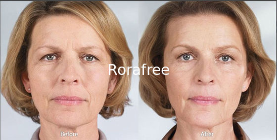  Poly-Lactic Acid for Stimulating The Regeneration of Collagen Dermal Filler supplier