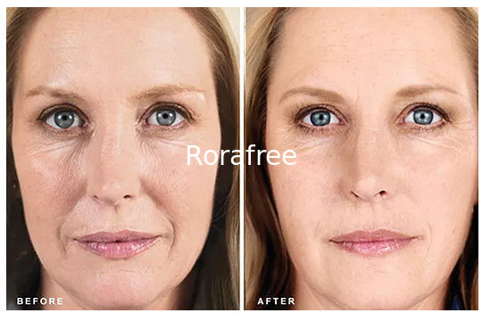 Hblve Injectable Stimulates Collagen Production  Plla Powder for Restore Youthful Facial supplier