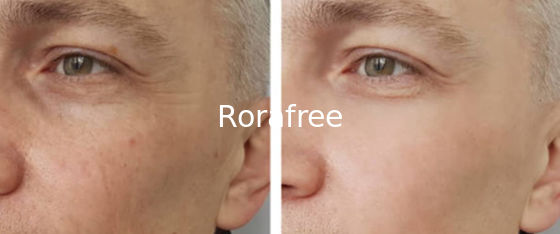 Best effect acido hialuronico reticulado cross linked hyaluronic acid lip injections dermal filler supplier