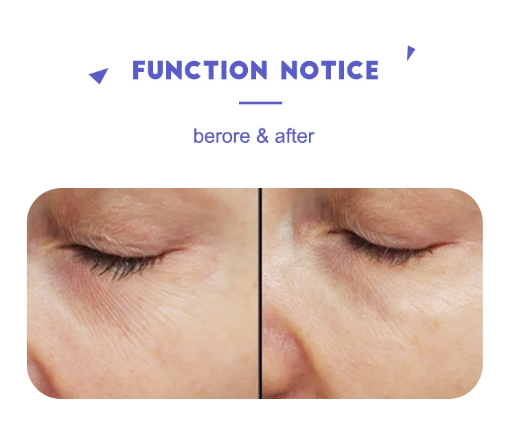 Nanosoft Microneedles Fillmed Hand Three Needles for Anti Aging Around Eyes and Neck Lines Skin Care Tool